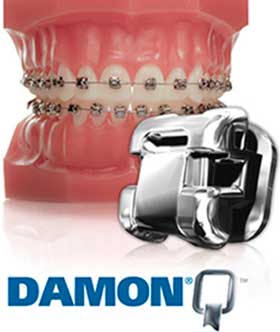 Sistema Damon Ortodoncia - Clínica dental Sanlúcar Barrameda