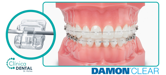 ortodoncia damon clear - clínica dental Sanlúcar Barrameda