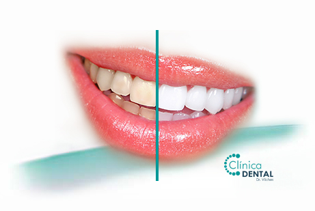 blanqueamiento dental - clínica dental Sanlúcar de Barrameda