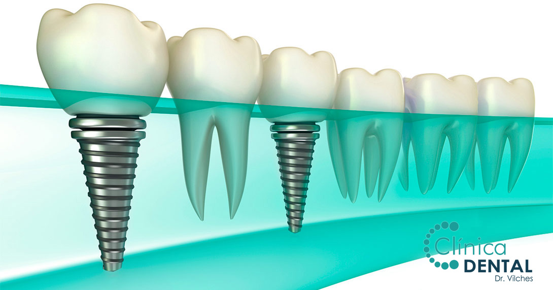 implantes dentales y cirugía dental Sanlúcar de Barrameda