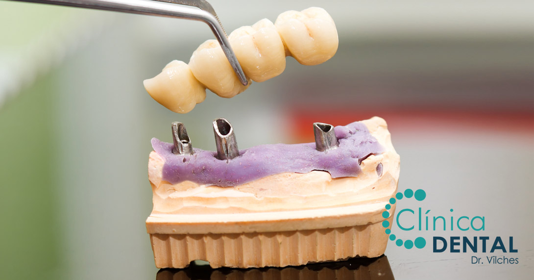 Prótesis fija Sanlúcar de Barrameda